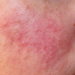 Rosacea